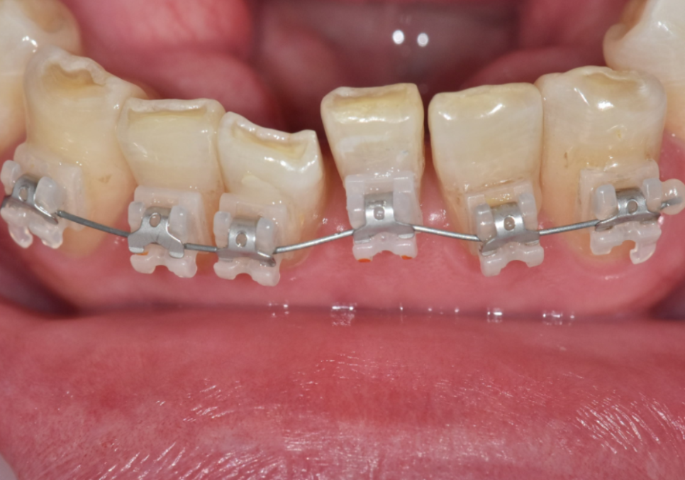 명일역 앞니 부분 교정, 치아 하나만 삐뚤어져 보인다면? 굳이 전체 교정할 필요 없습니다. 관련 이미지 3