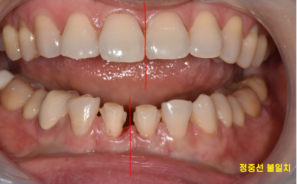 고덕동 치과에서 시행한 라미네이트와 치아 미백 과정 및 순서 관련 이미지 6