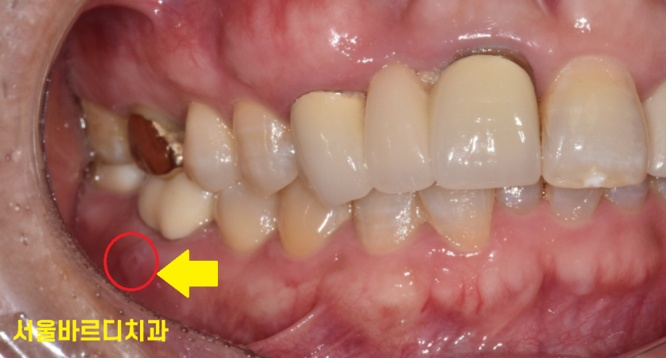잇몸 물집 강일역 치과에서 원인 알아보고 임플란트로 치료했습니다. 관련 이미지 2