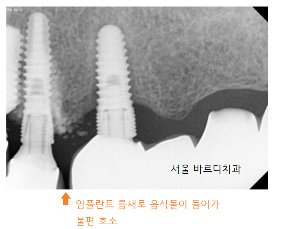 덕풍동 치과 오래된 임플란트 제거 후 재식립하였습니다. 관련 이미지 6