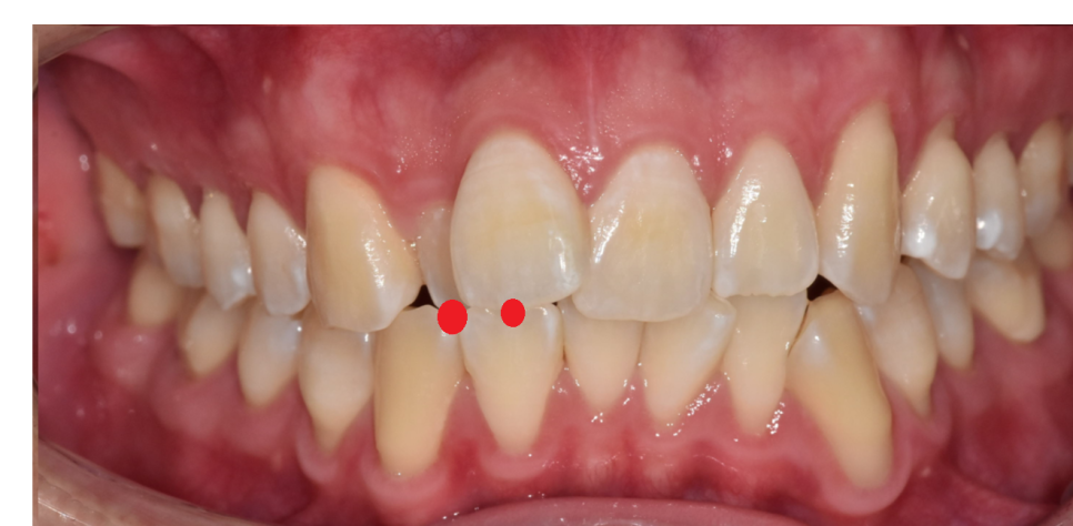 고덕역 교정치과 성인 부정교합 위아래가 거꾸로 물릴때는? 관련 이미지 3