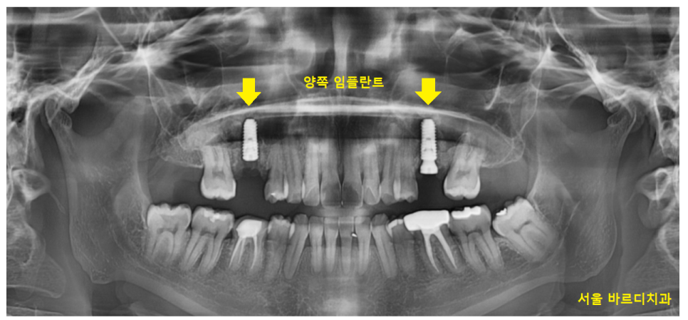 풍산동 치과 임플란트 양쪽 치료 가능한가요? 관련 이미지 11