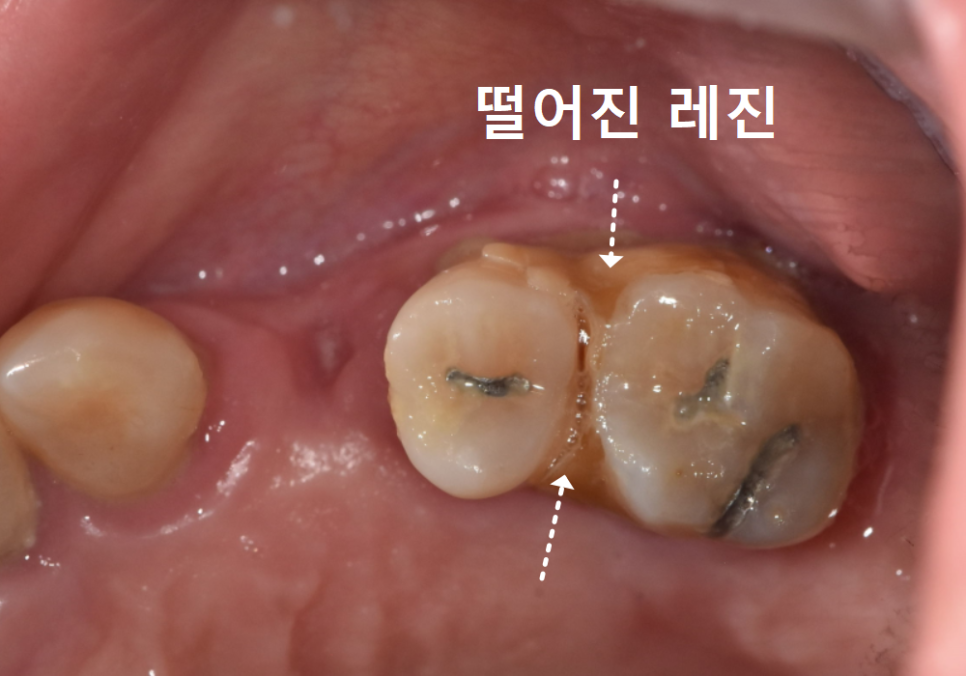 Gangil-dong Molar Implant, "It’s Loose—Can’t You Just Bond It with Resin?" image 1