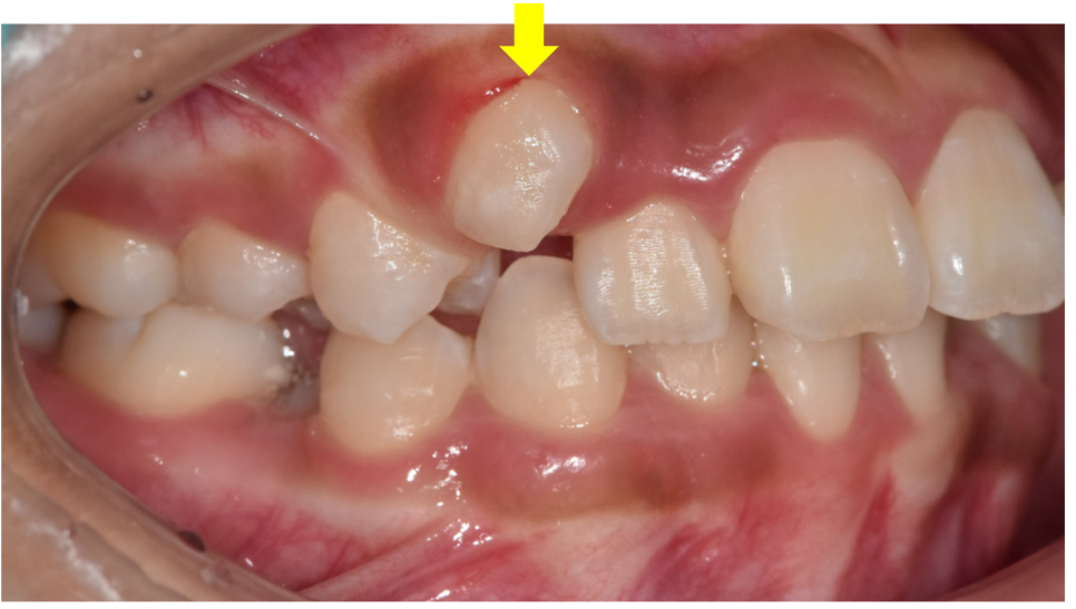 How to Correct a Canine Crowding Malocclusion: Extractions Are Necessary to Address Lip Protrusion image 2