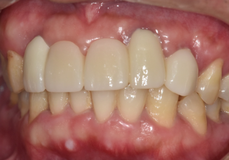 앞니 브릿지 부러짐, 이런 상태라면 절대 브릿지 다시 하지 마세요. 관련 이미지 15