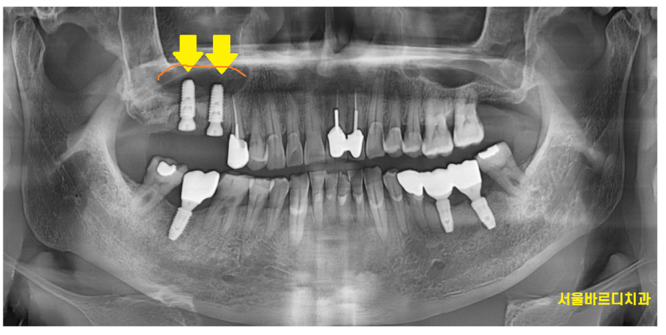 감일동 치과 어금니 시림 충치가 아닐 수도 있다? 임플란트 하게된 사연 관련 이미지 7