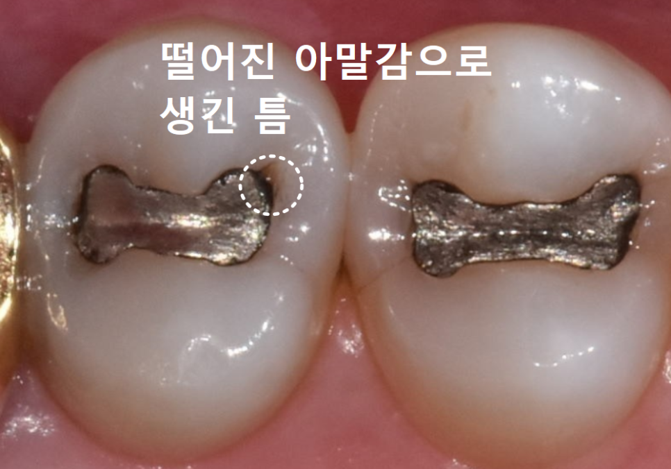 아말감 파절, 조금 깨졌을 뿐인데, 2차 충치로 치아 절반이 깨진 사연 관련 이미지 3