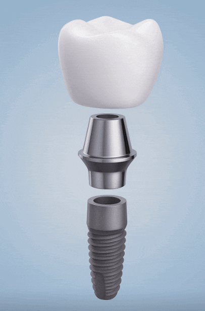 고덕동치과, 보험 임플란트? 추가 비용이 왜 나오는 거죠? 관련 이미지 1