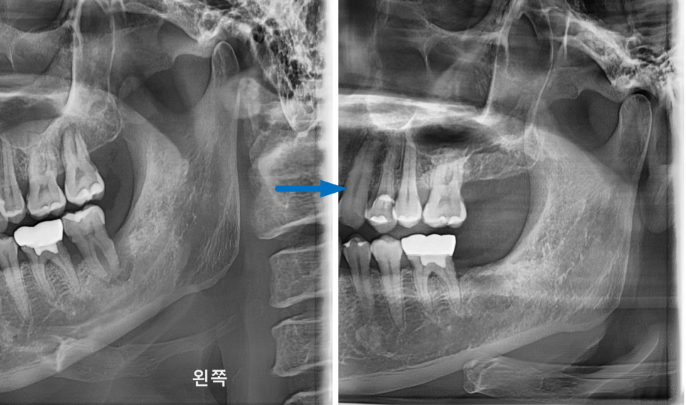 상일동치과 서울바르디치과 무절개 네비게이션 임플란트 치료증례 #7 관련 이미지 4