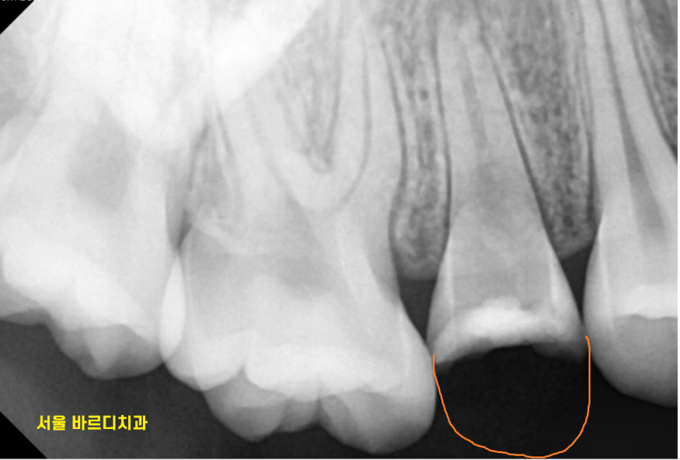 강일동 치과 추석 명절 딱딱한 음식은 절대 피하세요 치아 골절 생깁니다. 관련 이미지 4