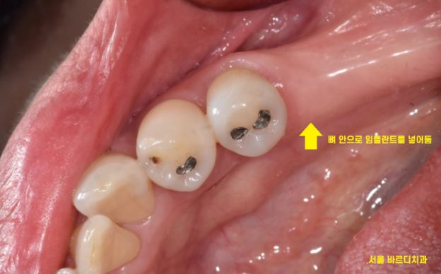 상일동역 치과에서 알려드리는 임플란트 수술과정 대공개 관련 이미지 7
