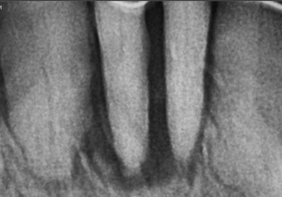강동구 임플란트 기간, 사람마다 왜 다를까? 즉시식립과 지연식립의 결정적 차이 관련 이미지 2