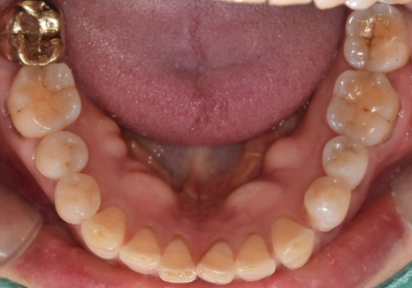 명일동 라미네이트 vs 크라운, 수명을 좌우하는 선택 기준 3가지 관련 이미지 7