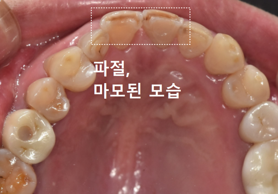 Gangdong-gu Dental Impressions: Are You Still Biting Down for 5 Minutes? We’ll Make It Comfortable with an Intraoral Scanner! image 9