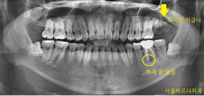 감일동 치과 첫번째 임플란트 시작이 중요합니다. 관련 이미지 2