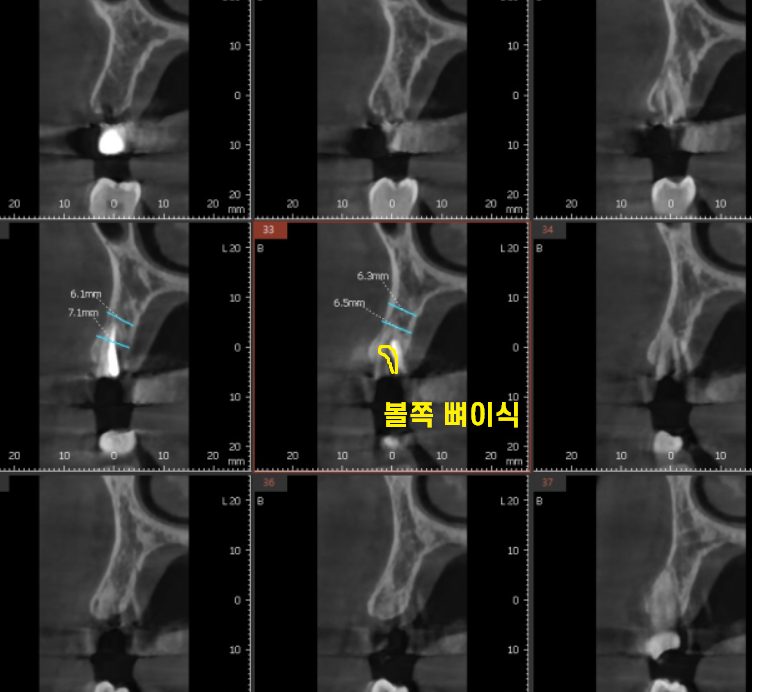 강동구 임플란트 치과 뿌리만 남은 치아 시작이 좋아야 끝도 좋으니까!! 관련 이미지 5