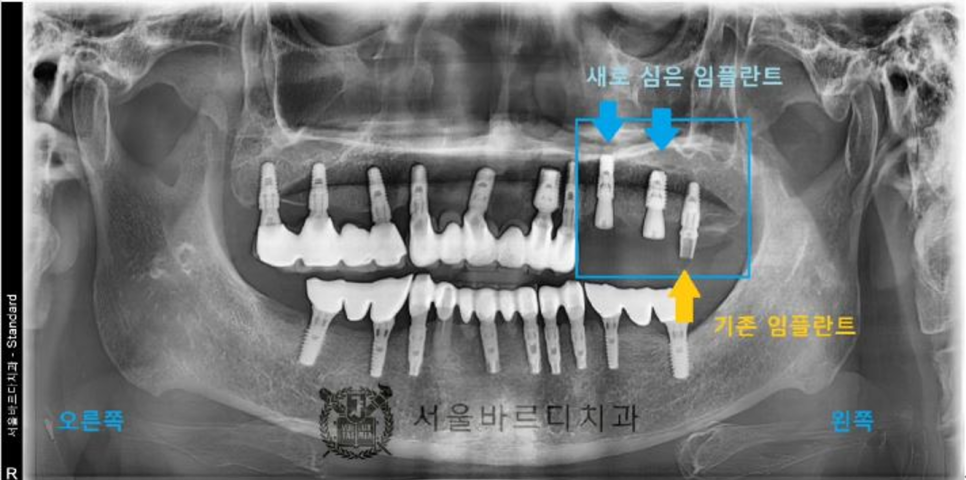 상일동역치과 서울바르디치과 무절개 네비게이션 임플란트 치료증례 #5 관련 이미지 13