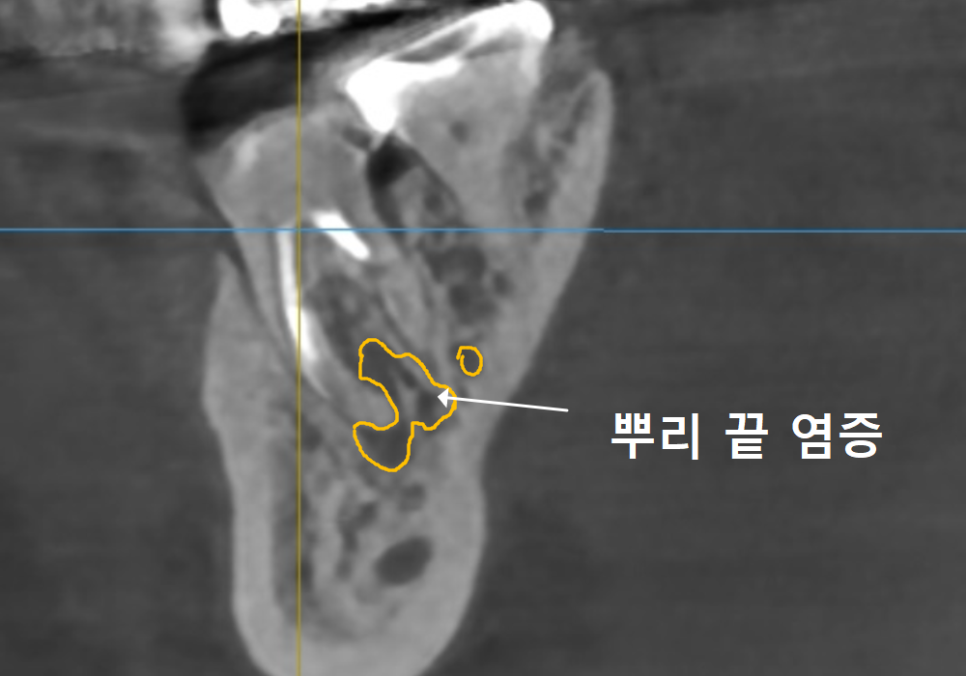 Honestly, Can an Unbroken Temporary Tooth Be Used Without a Crown? image 12