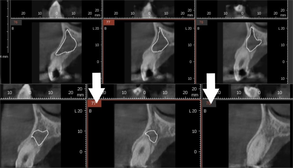 강동구 재신경치료, 왜 첫 치료보다 성공률이 낮다고 할까요? 관련 이미지 10