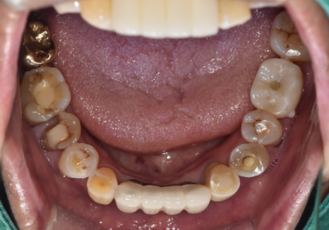 Cheonho Dental Clinic, Are You Over 65? We’re Revealing How to Reduce Denture and Implant Costs. image 6