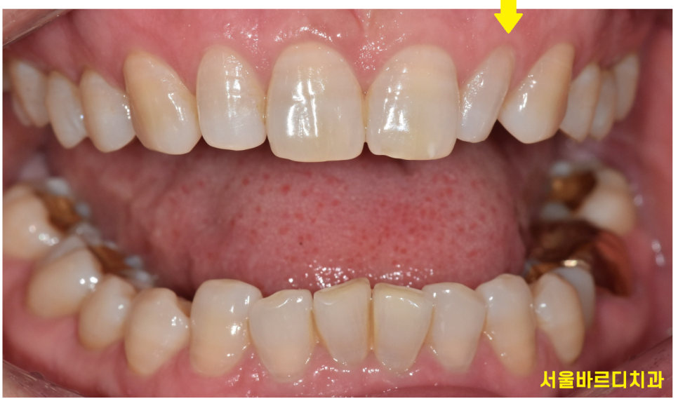 상일동역 라미네이트 치아 무삭제 정말 가능한가요? 관련 이미지 3