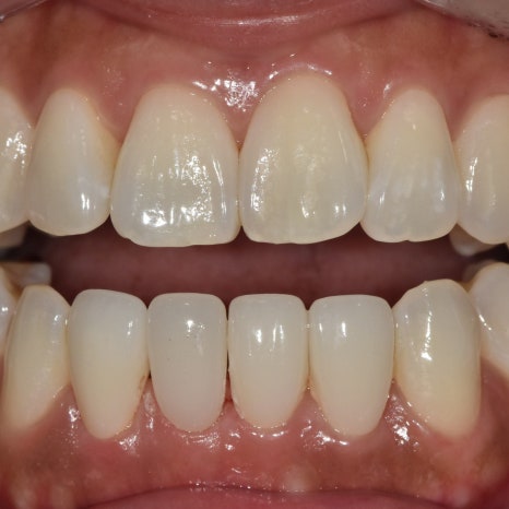 No-Prep Veneers: Do They Really Involve No Tooth Shaving? The 3 Questions Patients Ask Most image 2