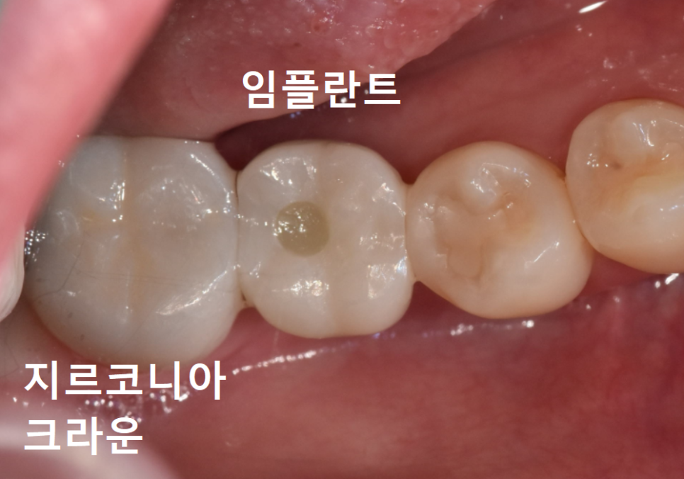 No space for an implant because a tooth has fallen over or a molar has tilted? Read this first. image 11