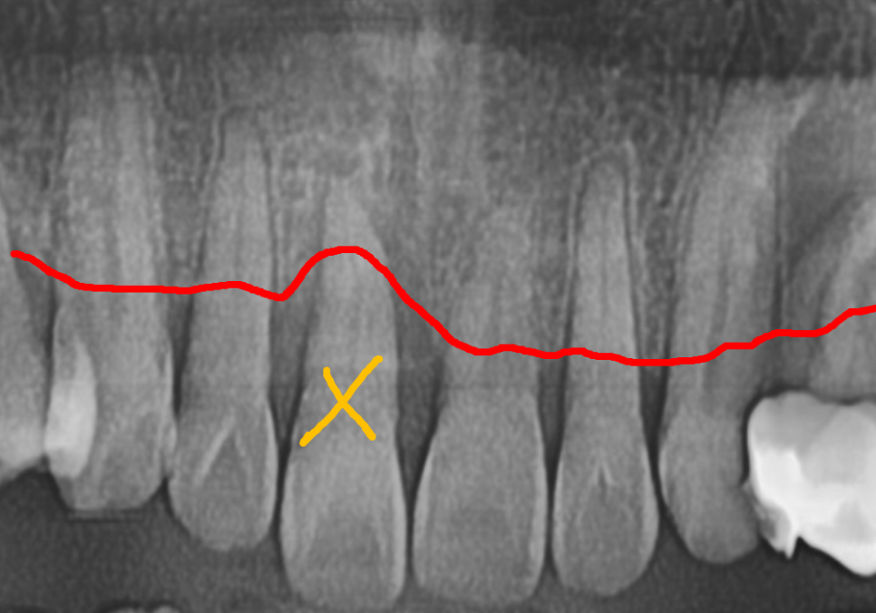 앞니 길어짐, 위 앞니가 점점 내려온다면? 관련 이미지 10