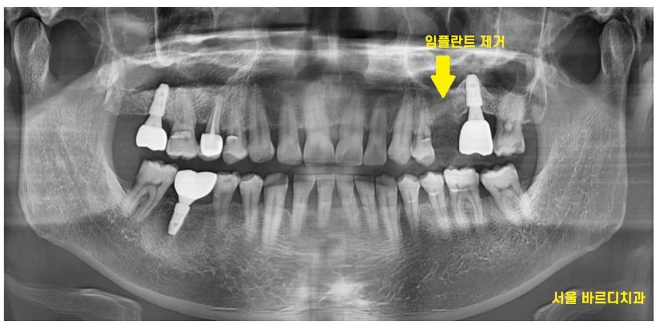 길동 치과 임플란트 보철 흔들림 교체 해야할 경우 관련 이미지 6