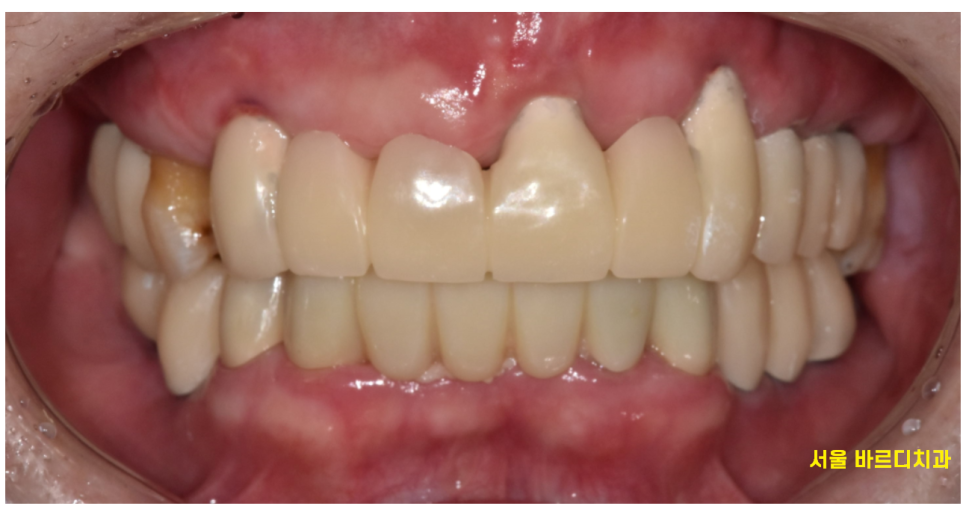 강동구 임플란트 어금니 상실 방치하다 치매까지 옵니다. 관련 이미지 13