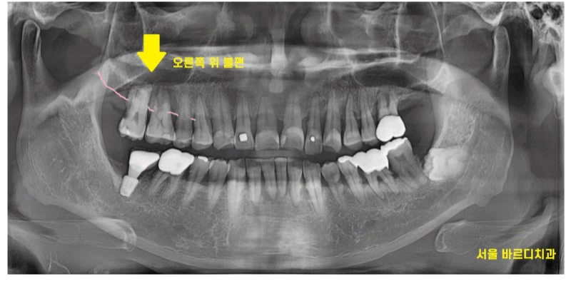 강일동 치과추천 어금니 시림 방치하다 발치하고 임플란트 하신 사연 관련 이미지 1