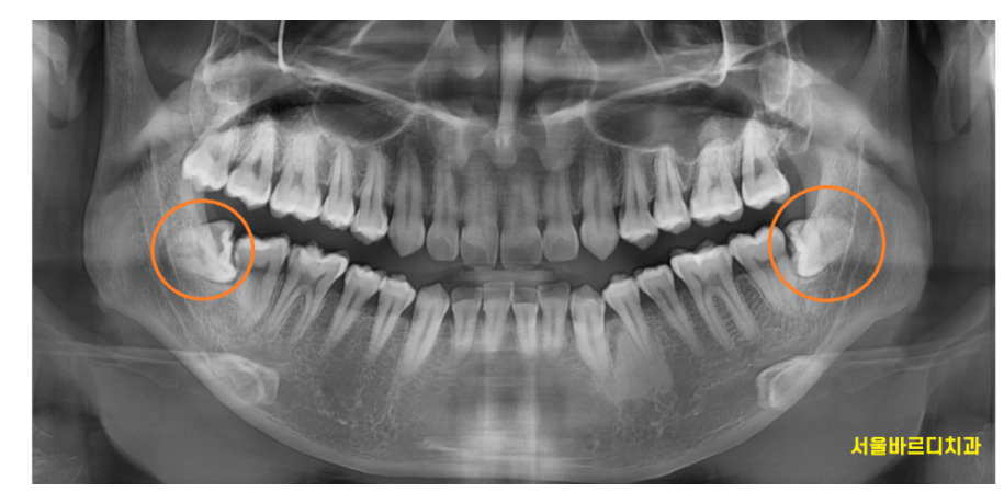 치아 교정 중 사랑니 뽑아야할까?? 관련 이미지 1