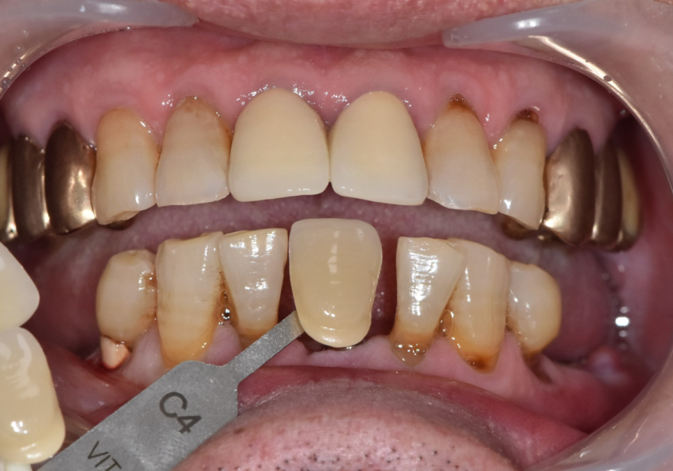 강동구 임플란트 가격 줄이는 방법 2개 발치했는데, 1개만 심어도 된다구요? 관련 이미지 10