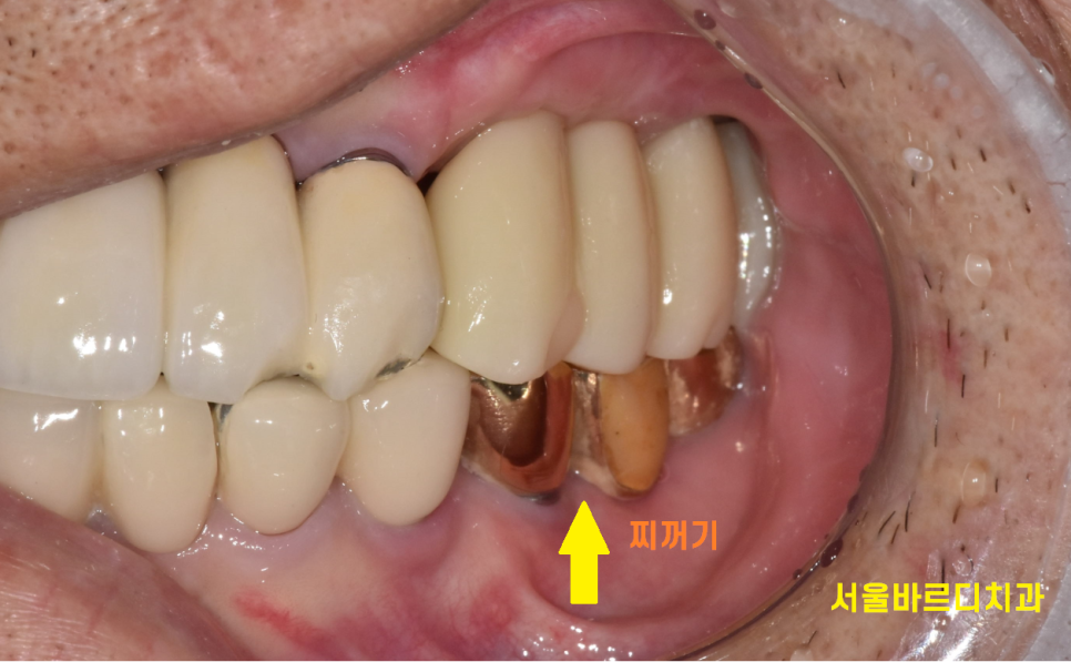 임플란트 잇몸 염증 반복되면 재수술도 필요합니다. 관련 이미지 4