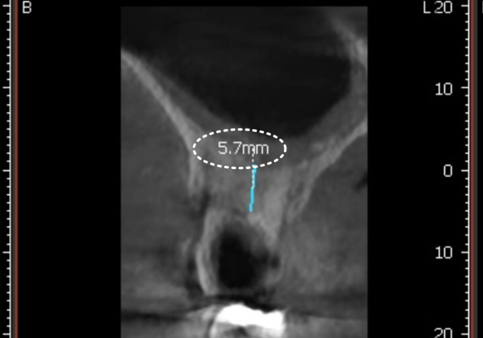 어금니 구멍, 충치 솔직하게 말씀드립니다. 치과 공포증으로 미루신 분들 필독 관련 이미지 7