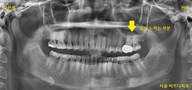 미사역 치과 어금니 뿌리 쪼개짐으로 발치 후 임플란트 했습니다! 관련 이미지 2