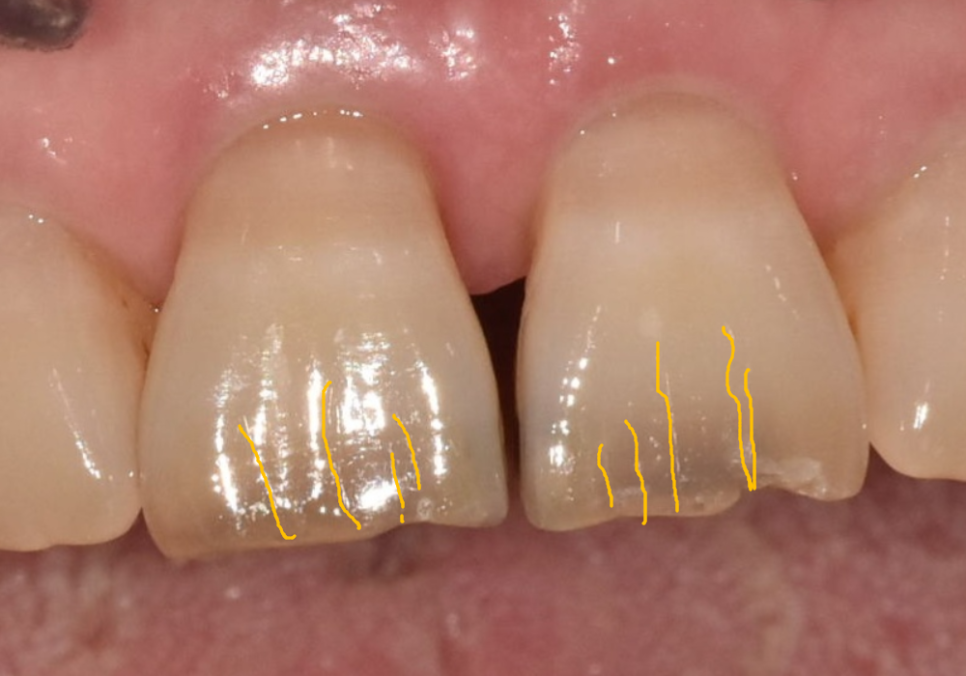 마모된 윗 앞니가 까맣게 변했다면? 방치하면 안 되는 이유 관련 이미지 8