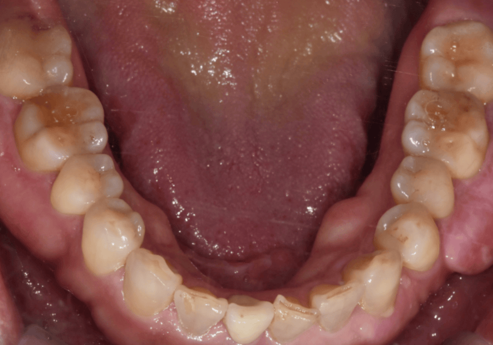 앞니 깨짐 치료 비용, 더이상 치과에 돈 낭비하기 싫다면? 깨지는 원인부터 알아야 합니다. 관련 이미지 4