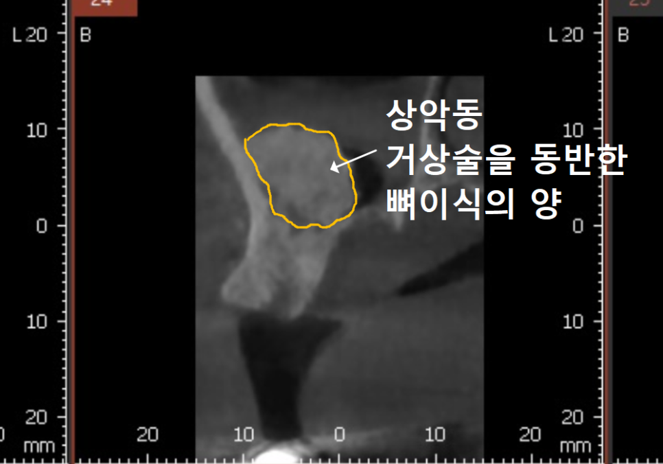 상악동 거상술 부작용 걱정되시나요? 재수술 없는 뼈이식의 정석 공개 관련 이미지 10