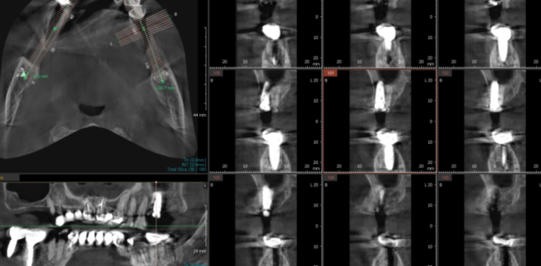 비절개 임플란트 추구하는 3가지 이유 관련 이미지 6