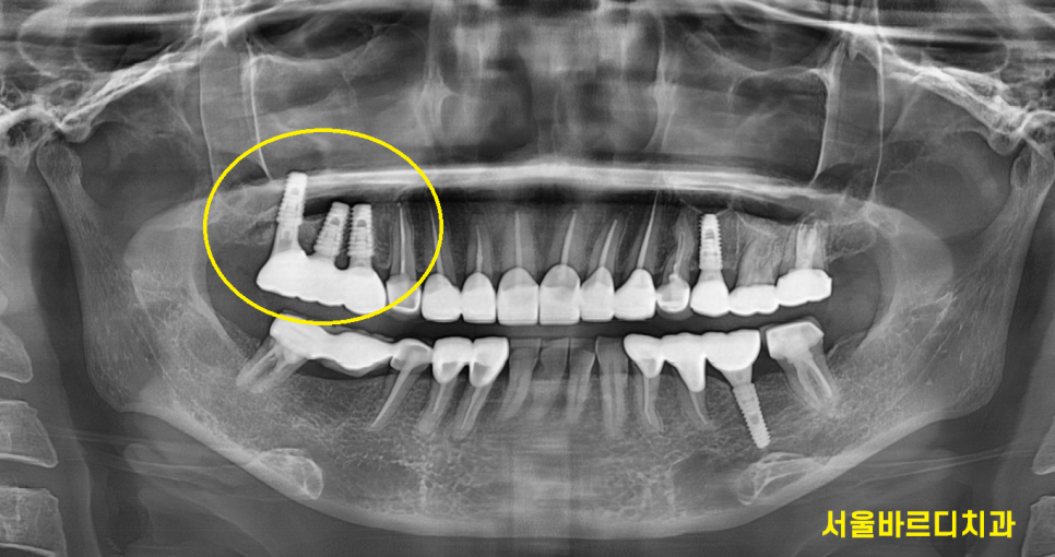 보철 부러짐 발생으로 치아 뿌리만 남았을 때 치료 방법 임플란트 관련 이미지 8