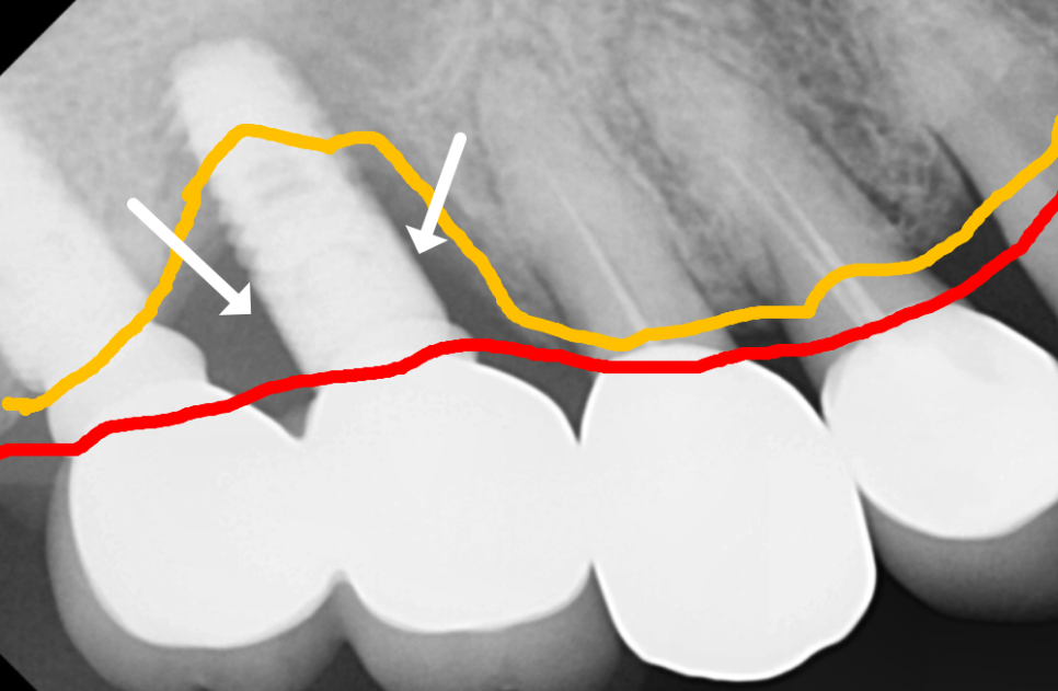 천호 디지털 가이드 임플란트, 일반 임플란트와 무슨 차이가 있나요? 관련 이미지 2