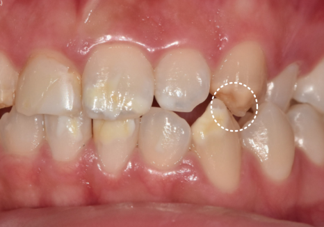 고덕역 치과 반점치 얼룩덜룩한 치아, 치료 실패 줄이는 5가지 기준 관련 이미지 6