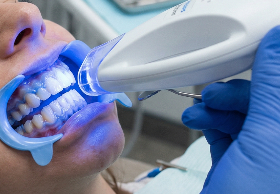 명일동 치과, 미백하면 연예인 치아처럼 새하얘진다는 말, 저는 못하겠습니다. 관련 이미지 4