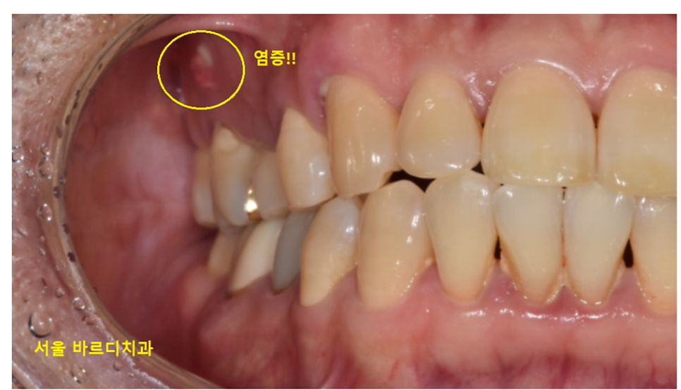 잇몸 곪음 피가 나오고 치통이 있을 때 관련 이미지 1