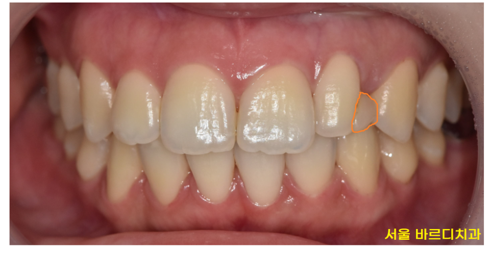 앞니 레진 변색으로 무삭제 라미네이트 진행했습니다. 관련 이미지 2