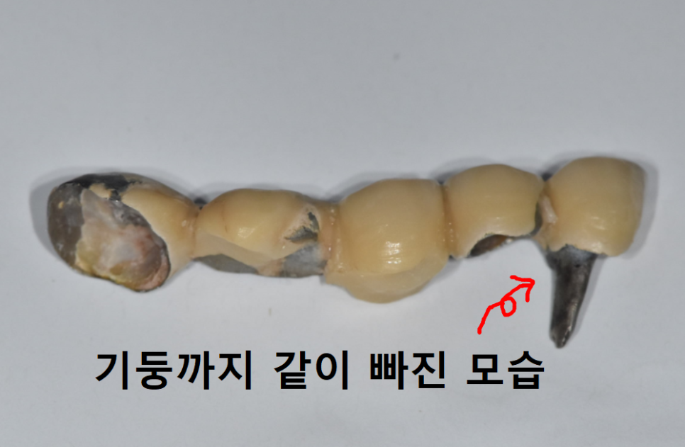 오래된 어금니 롱브릿지, 교체 타이밍을 놓치면 관련 이미지 5
