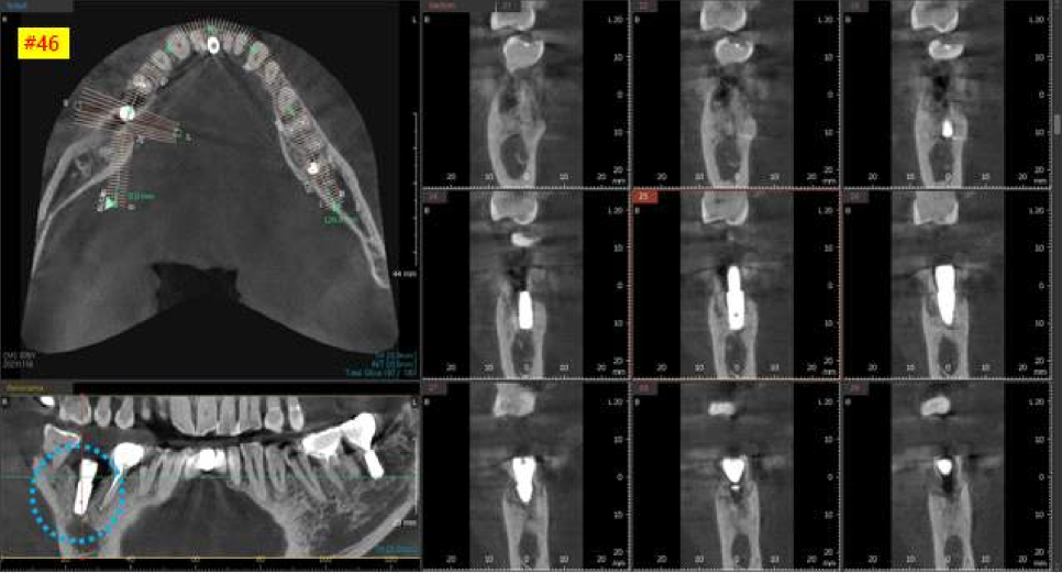 서울바르디치과 상하악 대구치 네비게이션 임플란트 치료증례 #4 관련 이미지 14