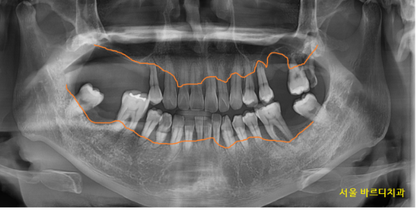 길동 치과 임플란트 뼈이식 후 흡연 상관 있을까? 관련 이미지 2