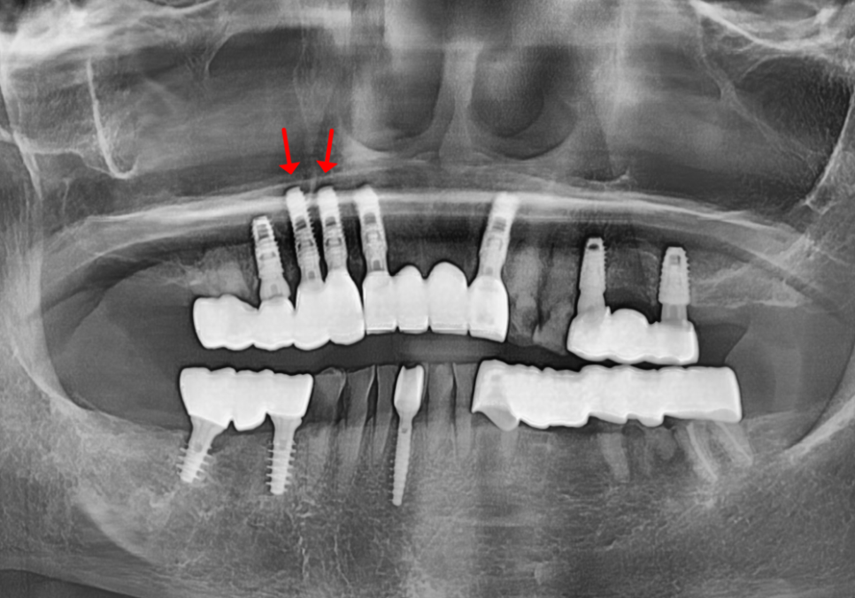상일동 임플란트 심한 충치로 인한 치아 부러짐 해결한 사례 관련 이미지 9